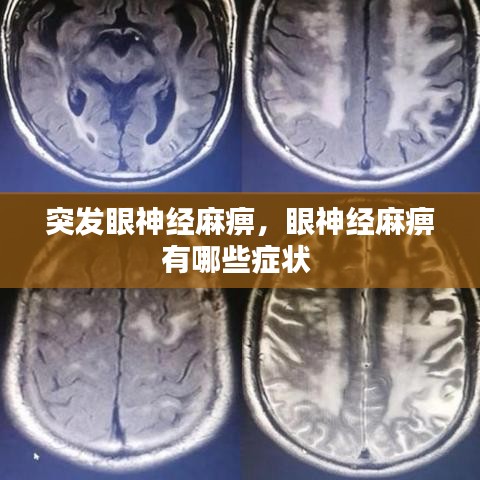 突发眼神经麻痹,眼神经麻痹有哪些症状